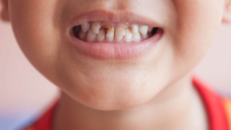 High tooth decay rates raise concerns – FBC News