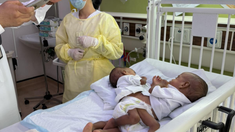 New hope for conjoined twins – FBC News